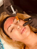 Micro-needling with PRP Skin Booster